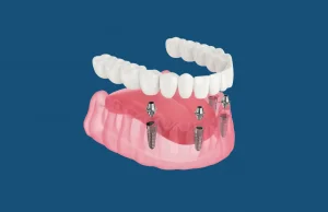 Implantacja zębów we Lwowie: dlaczego dziś to coś więcej niż tylko „wstawienie implantu”